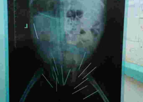 Medics at Thika Level 5 Hospital Remove 13 Needles from 10-Month-Old Girl