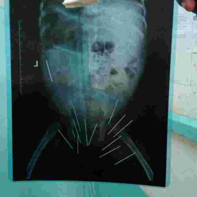 Medics at Thika Level 5 Hospital Remove 13 Needles from 10-Month-Old Girl