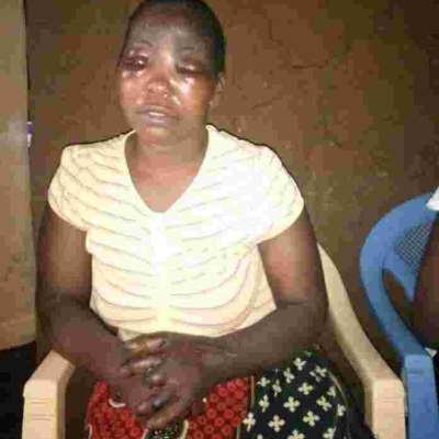Kenyan Woman Loses Eye, Three Fingers in Another Case of Domestic Violence