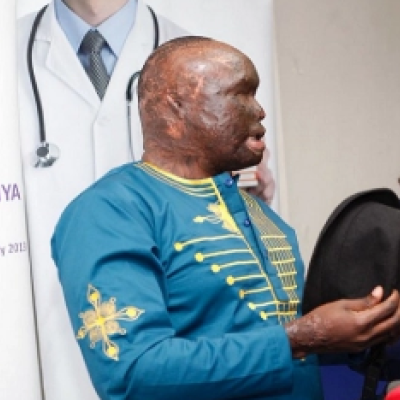 After 7 Years, Kenyan Acid Attack Survivor to Get Special Surgery in the US