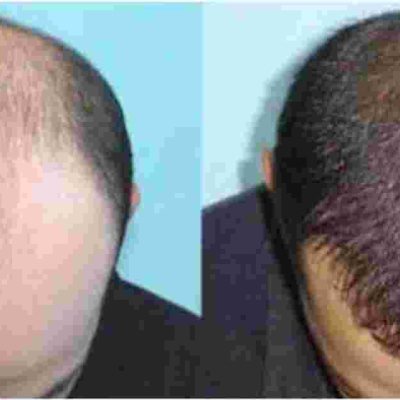Hair Transplant Clinic Opened in Nairobi