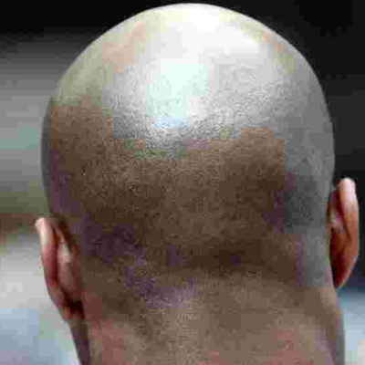  British Court Rules Calling a Man 'Bald' is Sexual Harassment