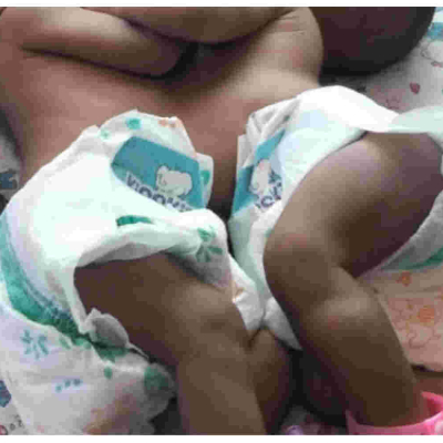 Kenyan Woman Appeals for Help After Giving Birth to Conjoined Twins