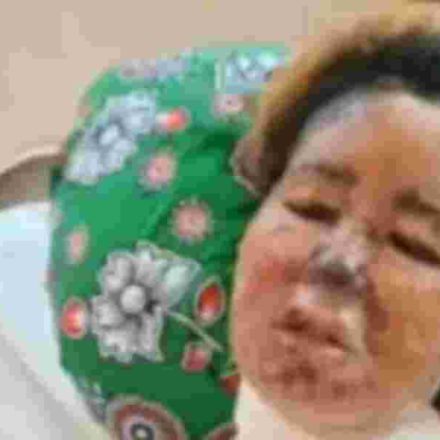 Mombasa Woman Fights for Her Life After Boyfriend Scalds Her Face with Boiling Oil 