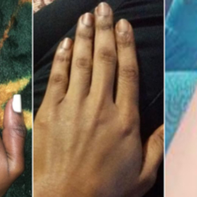 Kenya Battles Skin Bleaching Trend Despite Ban on 400 Dangerous Cosmetics